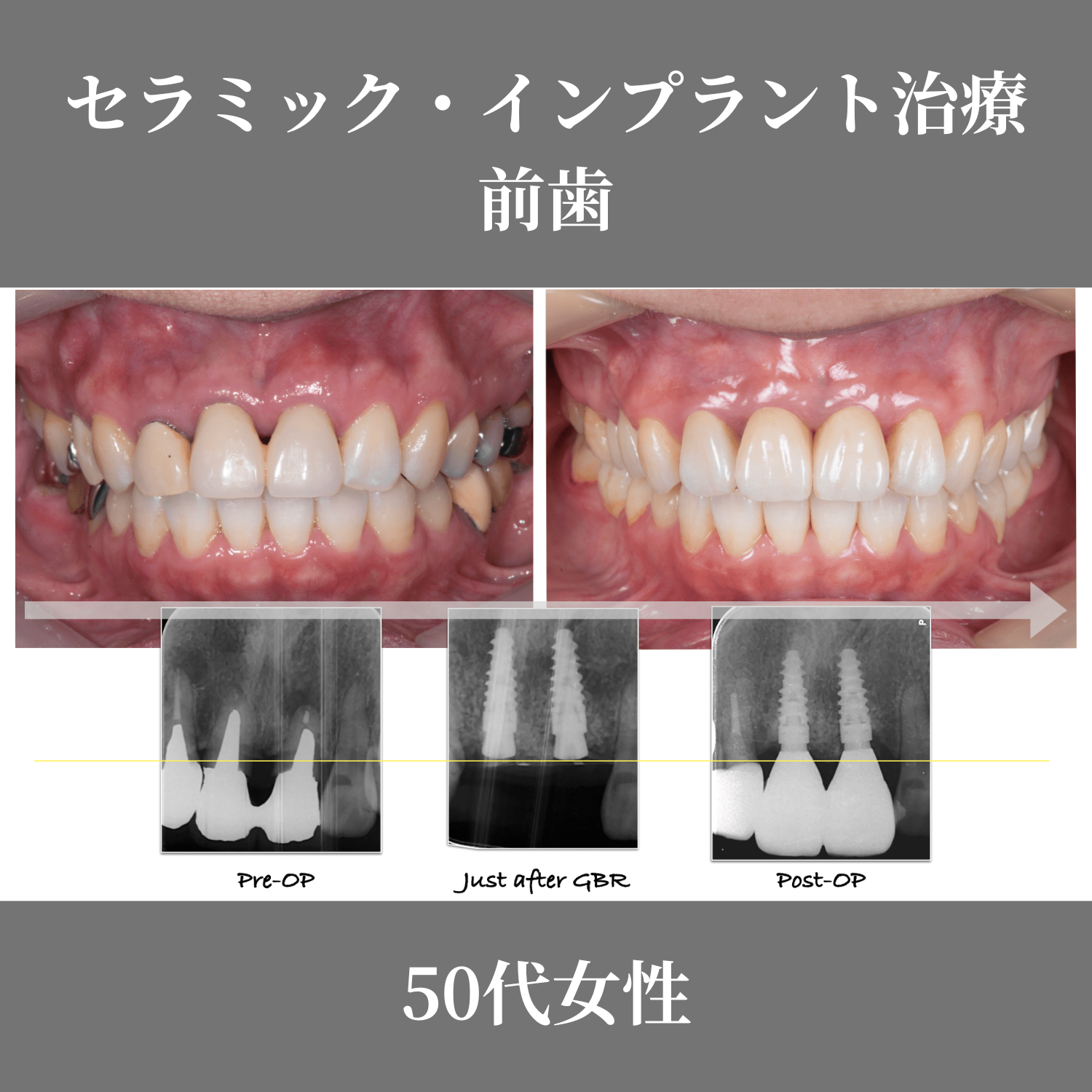 症例紹介7：インプラント・セラミック治療_前歯《50代女性