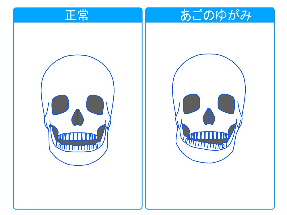 顎へのダメージ