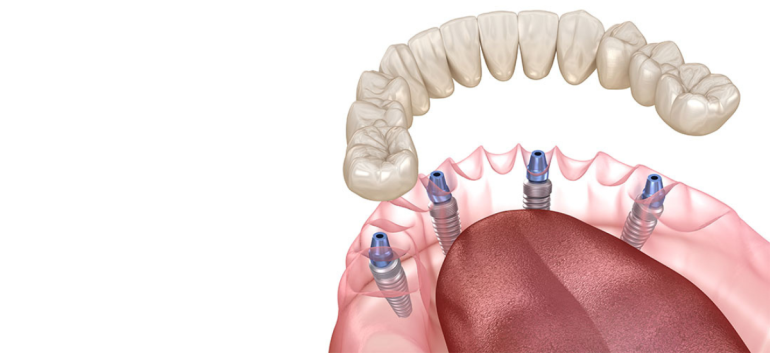 インプラント治療の一種：オールオンフォーとは何か