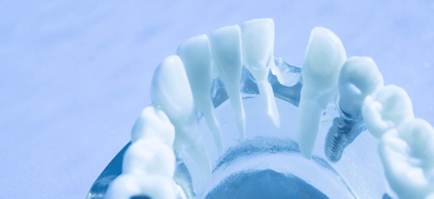 前歯インプラントの基礎知識