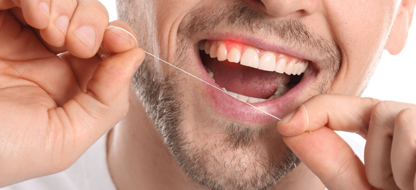 前歯インプラントの歯茎への影響