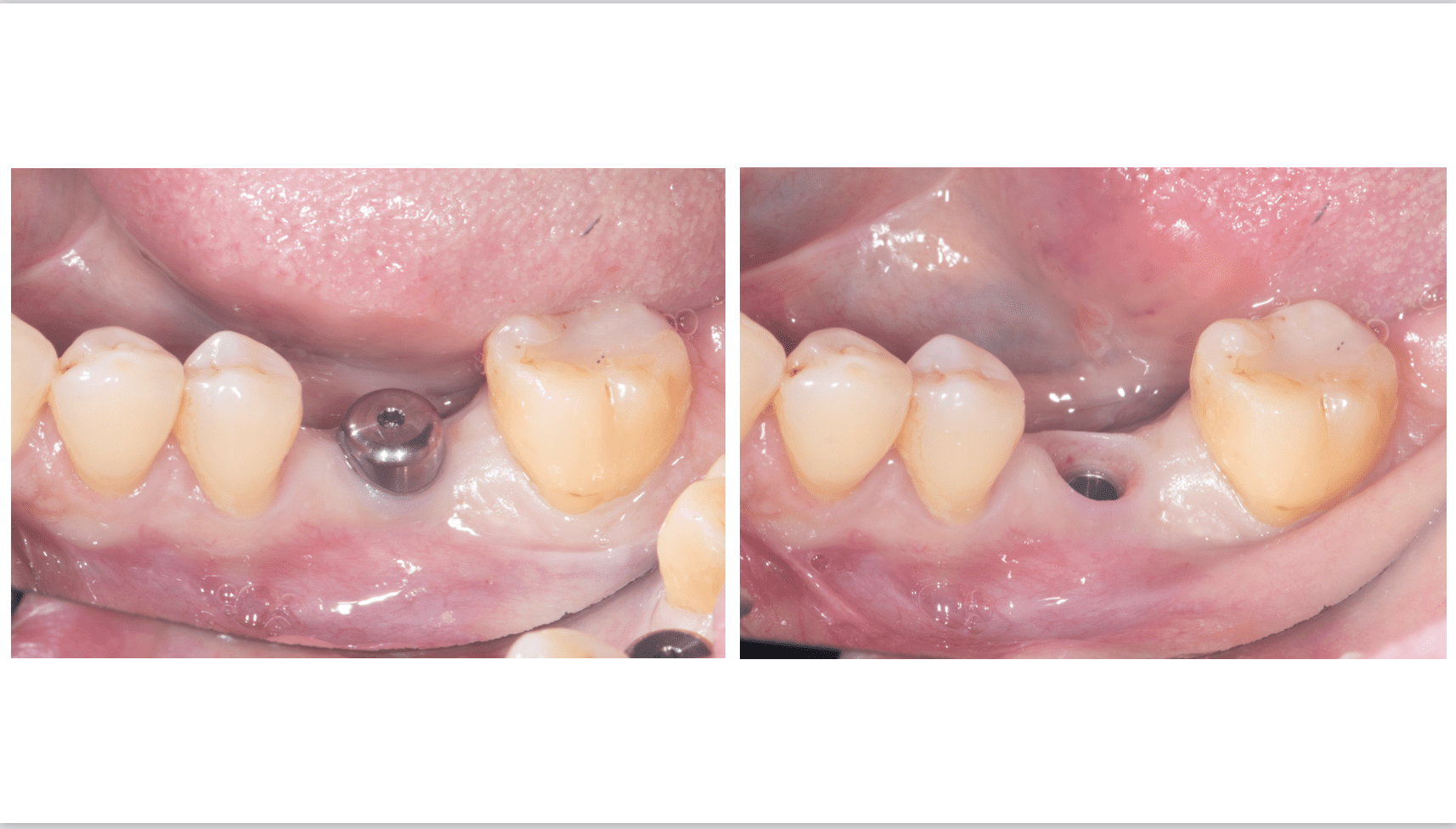 臼歯インプラント治療01-2