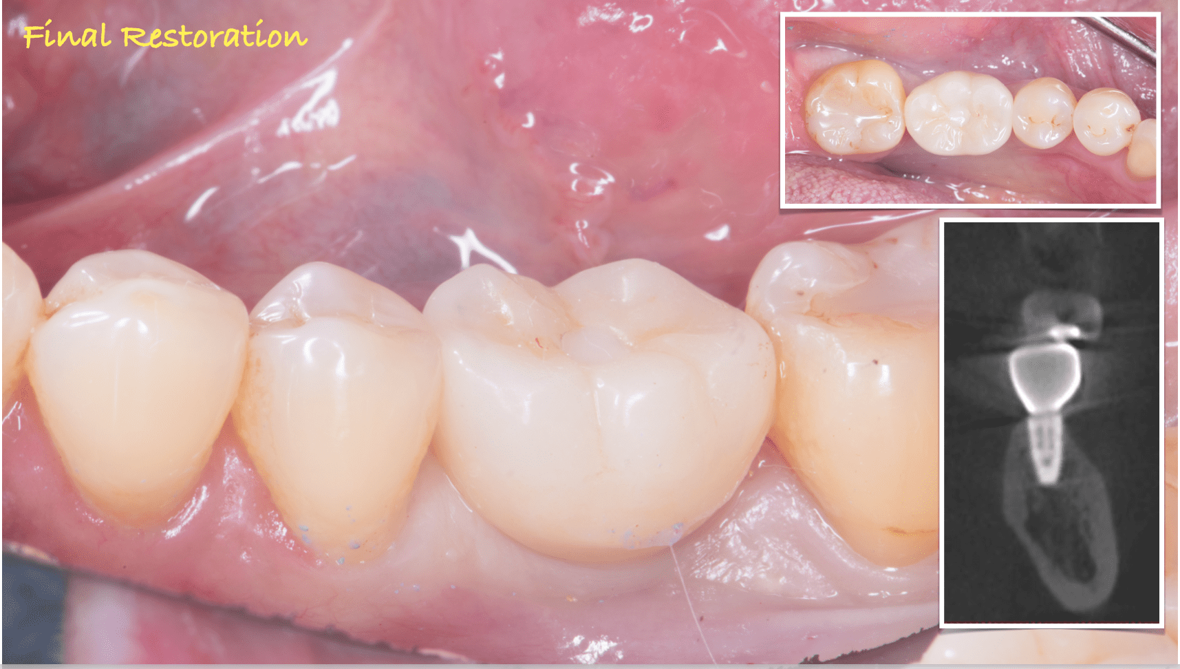 臼歯インプラント治療01-3