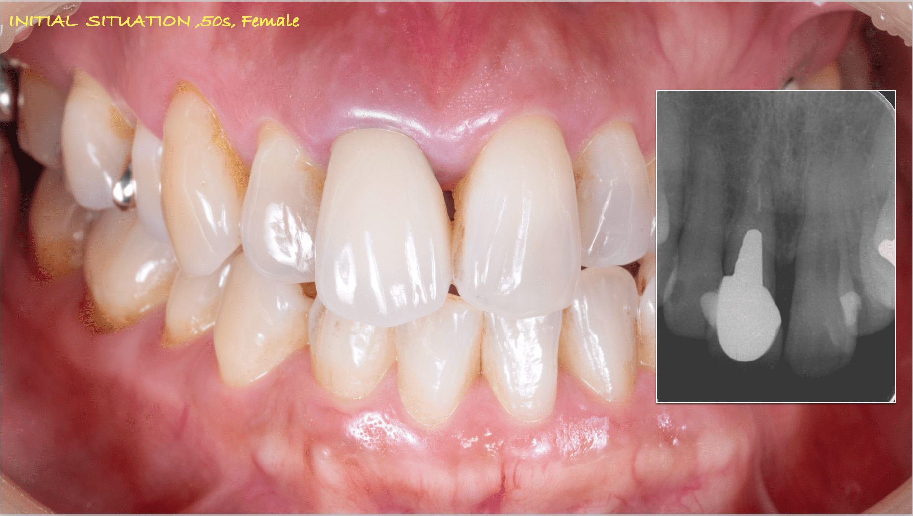前歯インプラント治療02-1
