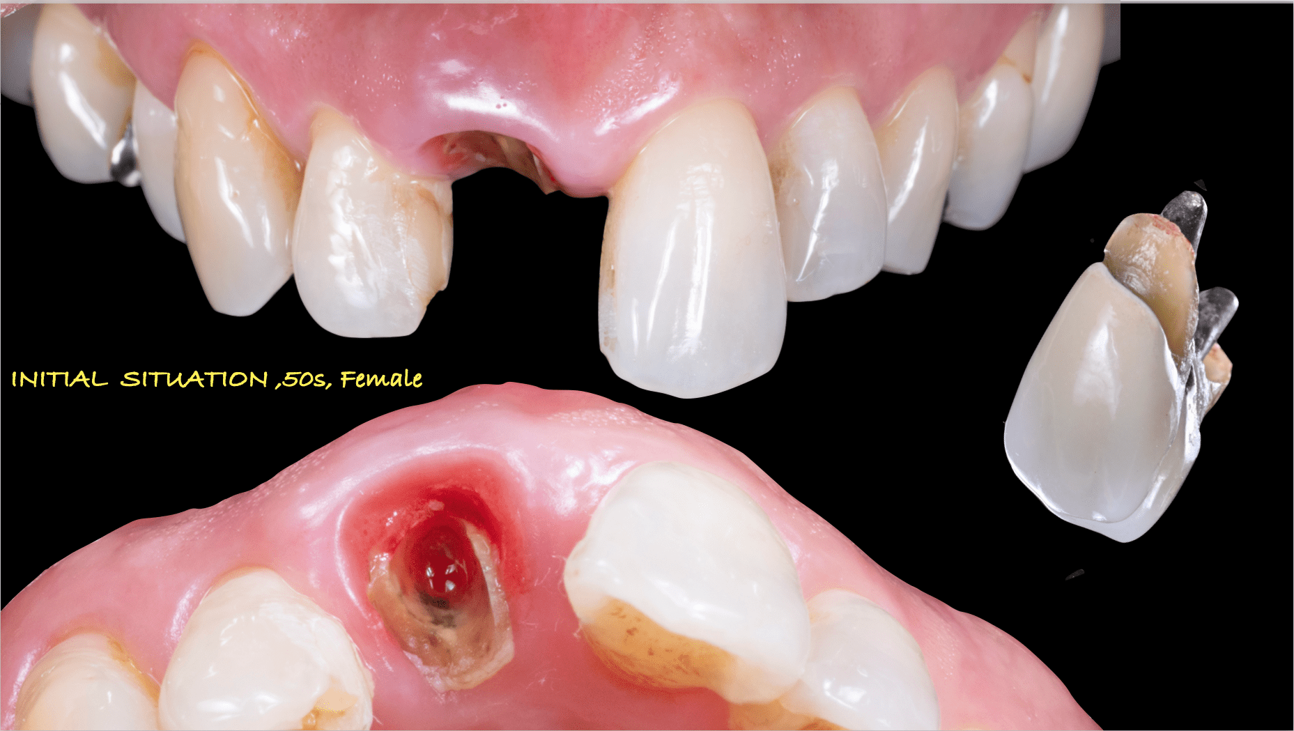 前歯インプラント治療02-2
