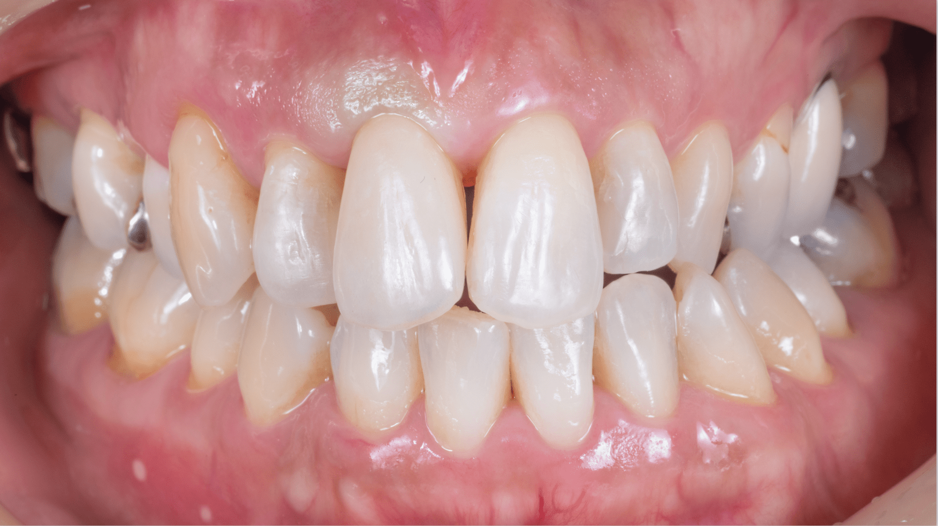 前歯インプラント治療02-4