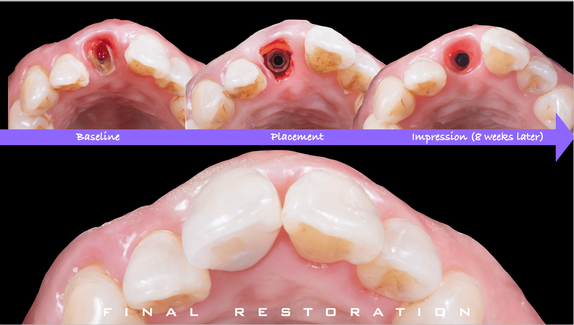 前歯インプラント治療02-5