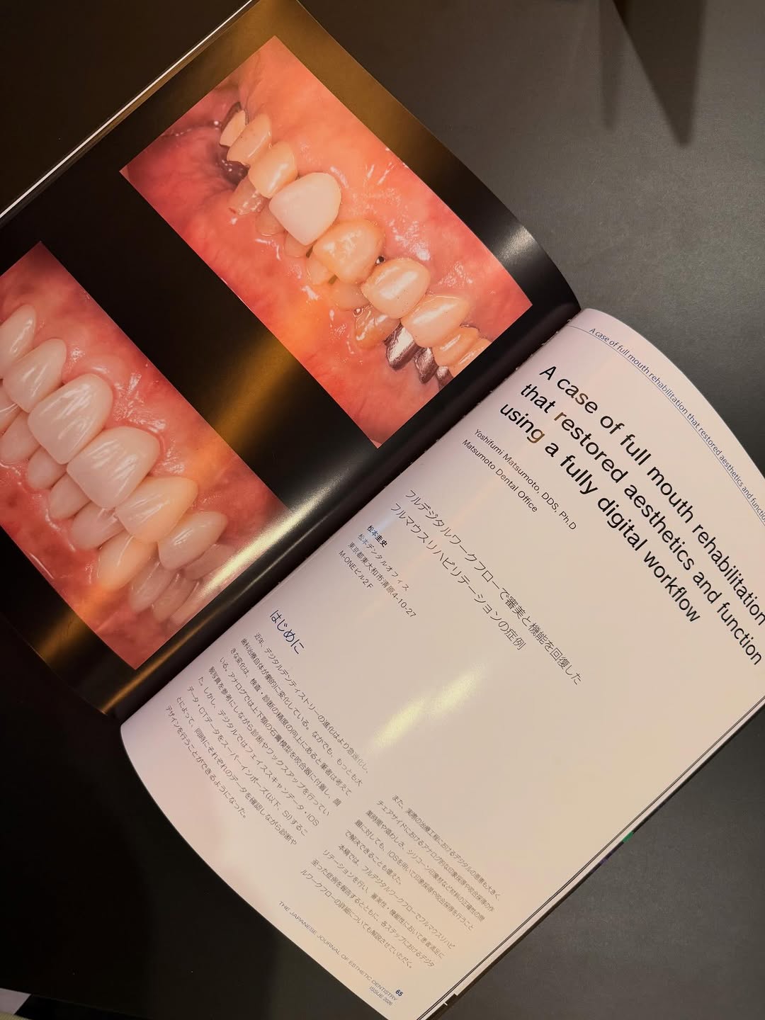 専門誌「The Japanese Journal of Esthetic Dentistry 2026」に症例を掲載していただきました②